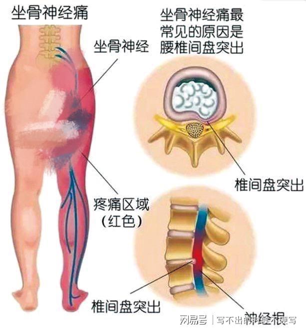 腰间盘突出怎样治，全面释义、实证解答解释落实