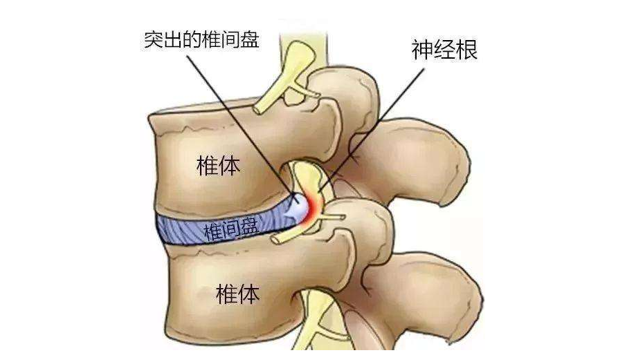 腰间盘突出怎样治详细解答、解释与落实、实证解答解释落实